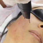 Face & Neck - Nitrogen Plasma Skin Regeneration